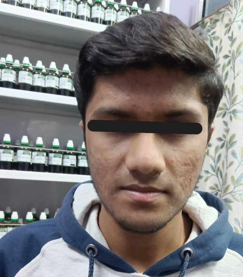 Sebaceous Acne - After